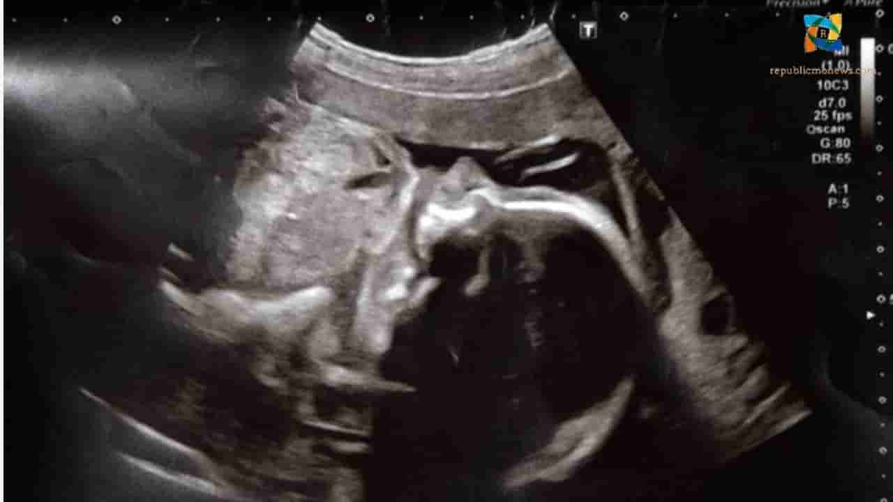 Hannah Cole Asked For a Baby Scan